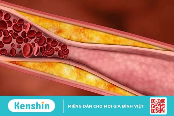 Quai động mạch chủ vồng nguy hiểm như thế nào?