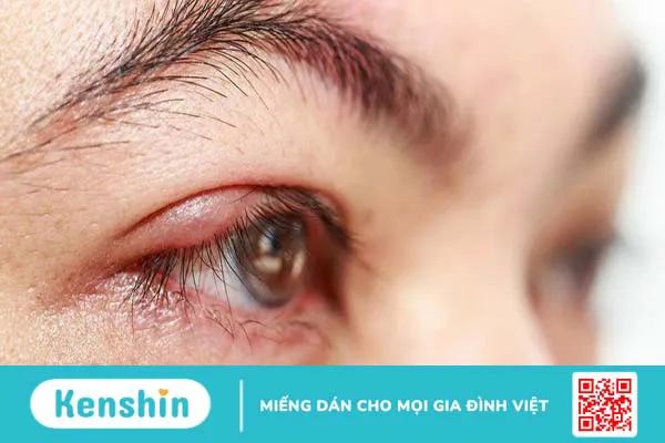 Quặm mi là gì? Tình trạng này có nguy hiểm không?