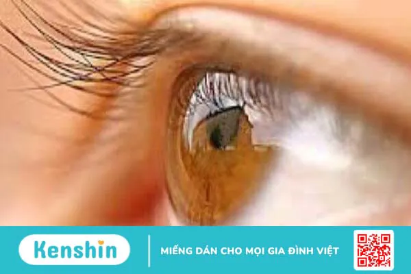 Quặm và lông xiêu của mí mắt có nguy hiểm không?