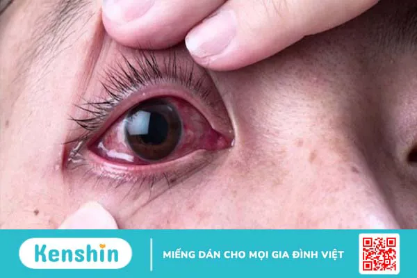 Quặm và lông xiêu của mí mắt là bệnh gì và nó nguy hiểm ra sao? 4