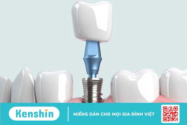 Quy trình cấy ghép implant cho những bệnh nhân bị mất răng