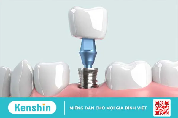 Quy trình cấy ghép implant cho những bệnh nhân bị mất răng