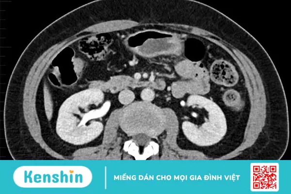 Quy trình chụp CT Scanner hệ tiết niệu chi tiết nhất