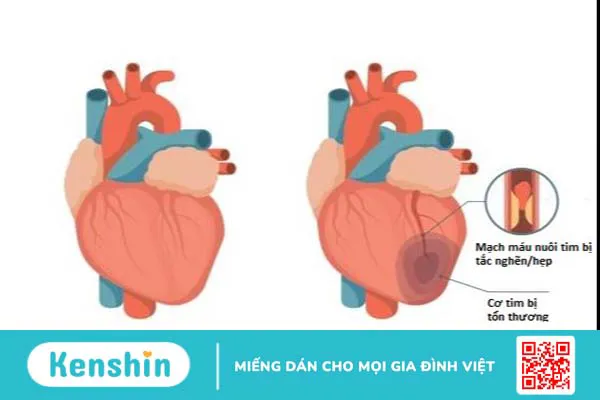 Suy tim là gì? Khám bệnh nhân suy tim gồm những gì? 2