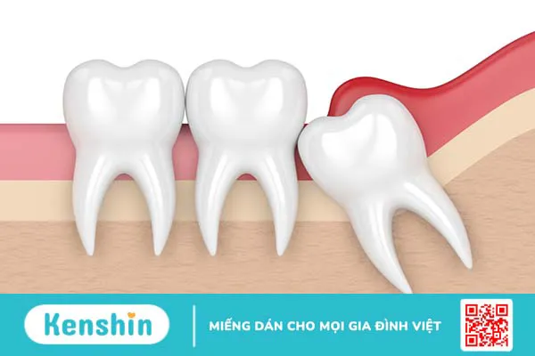 Quy trình nhổ răng khôn được tiến hành như thế nào? Cần lưu ý điều gì?