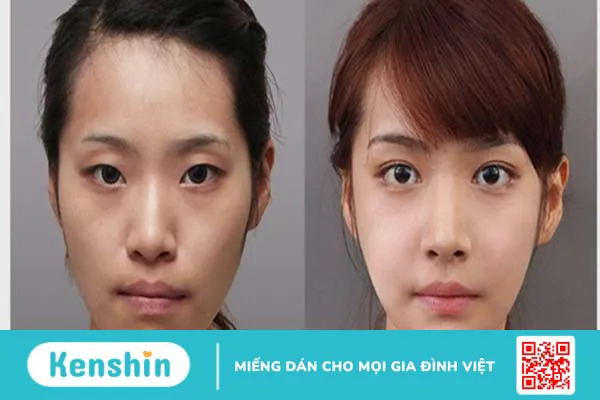 Quy trình phẫu thuật chỉnh hàm hô và những lưu ý sau phẫu thuật