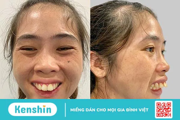 Quy trình phẫu thuật chỉnh hàm hô và những lưu ý sau phẫu thuật