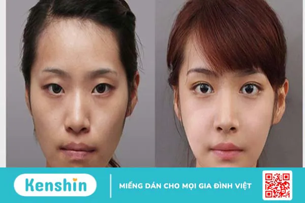 Quy trình phẫu thuật chỉnh hàm hô và những lưu ý sau phẫu thuật