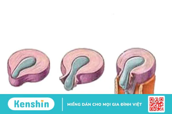 Rách bao xơ đĩa đệm: Nguyên nhân, dấu hiệu và biện pháp phòng ngừa