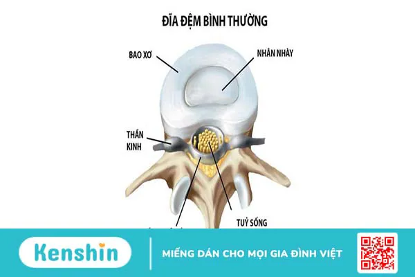 rách bao xơ đĩa đệm 1