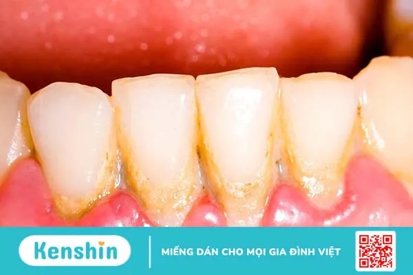 Răng bị vôi đóng nhiều có nguy hiểm hay không?