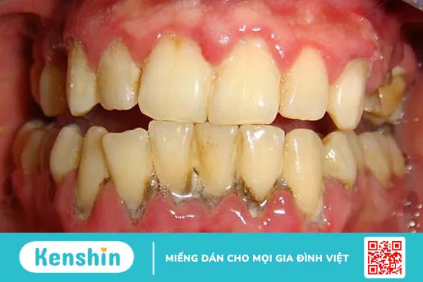 Răng bị vôi đóng nhiều có nguy hiểm hay không?