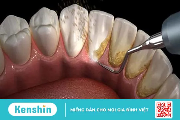 Răng bị vôi đóng nhiều có nguy hiểm hay không?