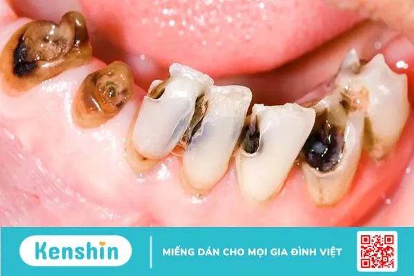 Răng cửa bị sâu đen: Nguyên nhân và cách khắc phục