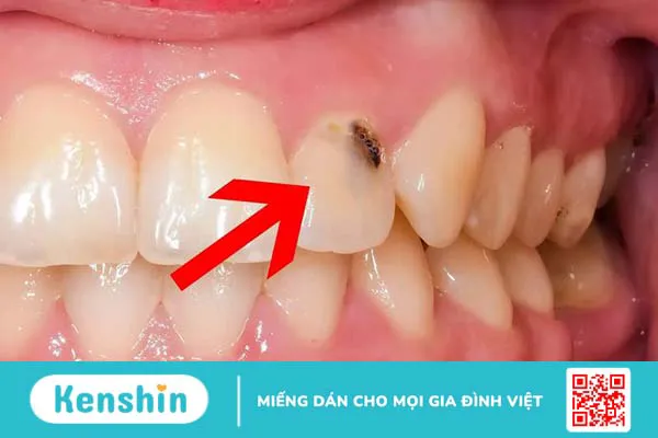 Răng cửa bị sâu đen: Nguyên nhân và cách khắc phục