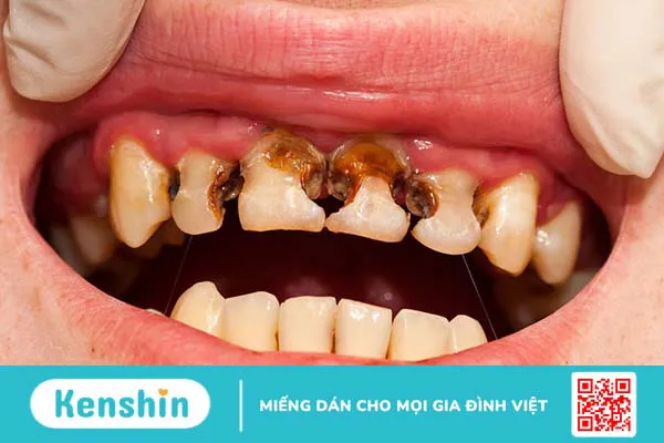 Răng cửa bị sâu đen: Nguyên nhân và cách khắc phục