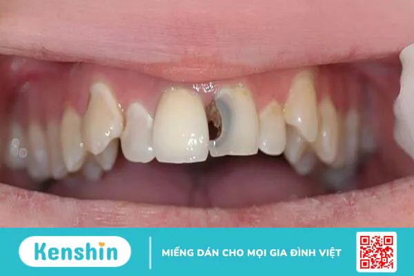 Răng cửa bị sâu đen phải làm sao?