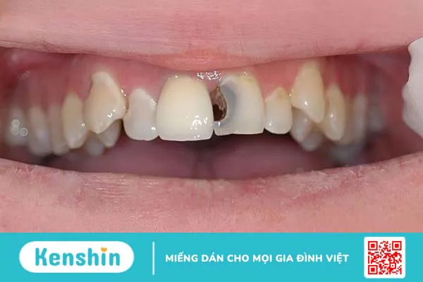 Răng cửa bị sâu đen phải làm sao?