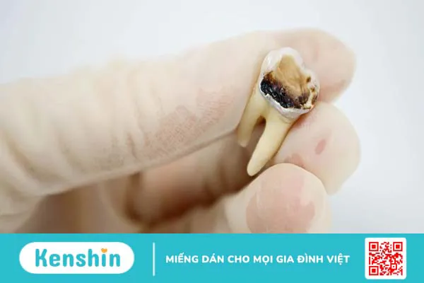 Răng hàm bị sâu chỉ còn chân răng gây ra những ảnh hưởng gì?