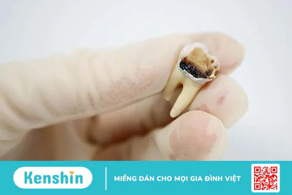 Răng hàm bị sâu chỉ còn chân răng gây ra những ảnh hưởng gì? 1