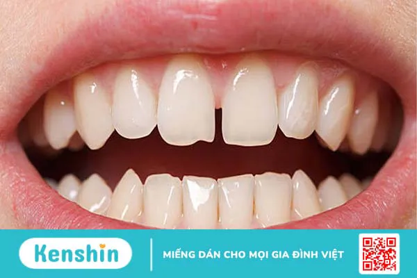 Răng sứ Orodent là gì? Khi nào cần bọc răng sứ?