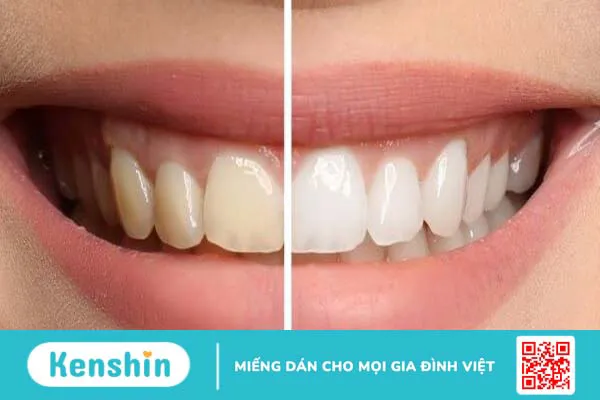 Răng vàng hay răng trắng tốt hơn? Cách chăm sóc răng miệng tại nhà