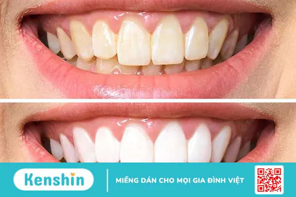 Răng vàng hay răng trắng tốt hơn? Cách chăm sóc răng miệng đúng chuẩn? 2