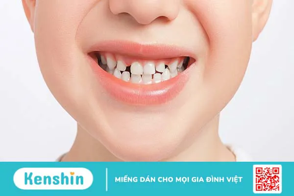 Răng xấu nguyên nhân là gì? Cách điều trị phục hồi tình trạng này