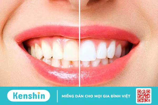 Răng xấu nguyên nhân là gì? Cách điều trị phục hồi tình trạng này? 2