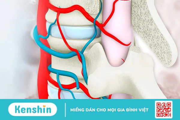 Rò động – tĩnh mạch màng cứng tủy sống: Cơ chế, triệu chứng bệnh và phương pháp điều trị