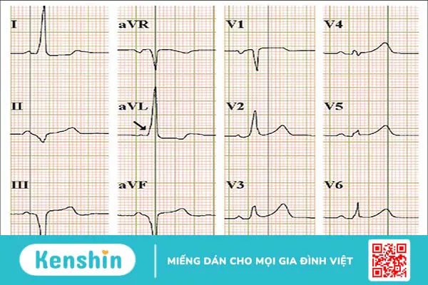 Rối loạn nhịp tim nhanh trên thất: Nguyên nhân và cách điều trị hiệu quả 2