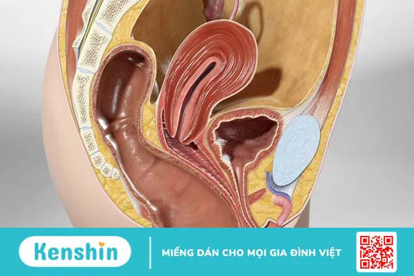 Sa trực tràng kiểu túi là gì? Triệu chứng và cách điều trị