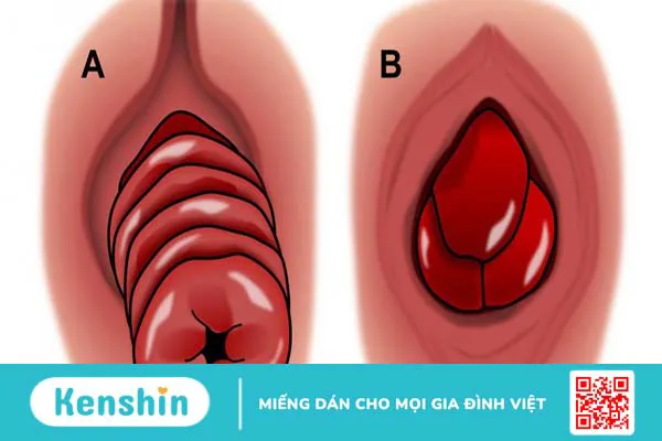 Sa trực tràng và trĩ có giống nhau không? Cách phân biệt