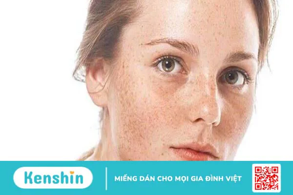 Sắc tố da là gì? Những bệnh lý liên quan đến sự thay đổi sắc tố da