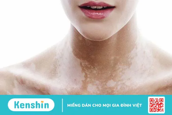 Sắc tố da là gì? Những bệnh lý liên quan đến sự thay đổi sắc tố da