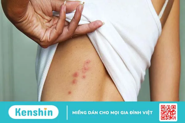 Sẩn ngứa: Nguyên nhân, dấu hiệu và phương pháp điều trị