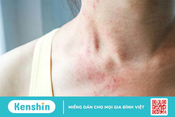 Sẩn ngứa: Nguyên nhân, dấu hiệu và phương pháp điều trị