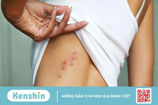 Sẩn ngứa: Nguyên nhân, dấu hiệu và phương pháp điều trị