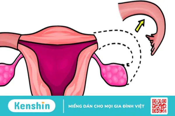 Sau khi cắt vòi trứng có kinh nguyệt không? Có ảnh hưởng tới việc mang thai sau này không?