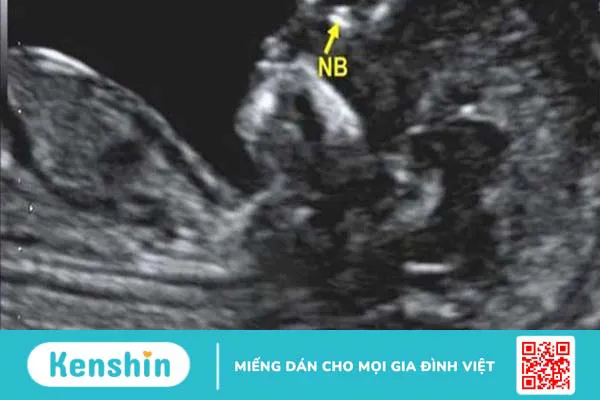 Siêu âm 2D có đo được độ mờ da gáy không? Có chính xác không?