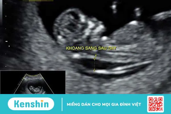 Siêu âm 2D có đo được độ mờ da gáy không? Có chính xác không?