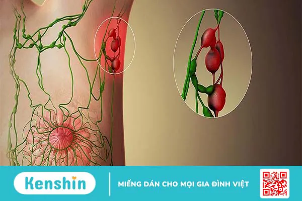 Sinh thiết hạch gác cửa có ý nghĩa như thế nào trong ung thư vú?