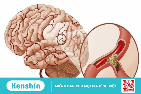 Sinh thiết não là gì? Có nguy hiểm không? 3