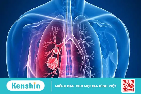 Sinh thiết phổi là gì? Sinh thiết phổi bao lâu thì có kết quả?