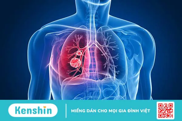 Sinh thiết phổi là gì? Sinh thiết phổi bao lâu thì có kết quả?