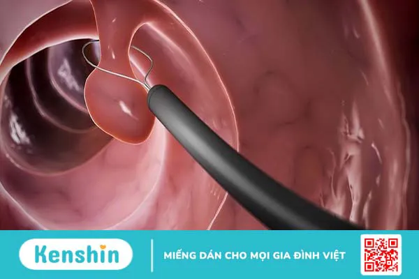 Sinh thiết polyp dạ dày là gì? Khi nào cần sinh thiết polyp dạ dày?