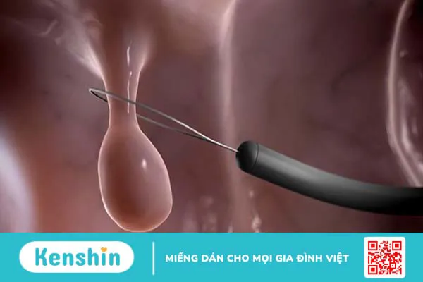 Sinh thiết trực tràng và những điều cần biết