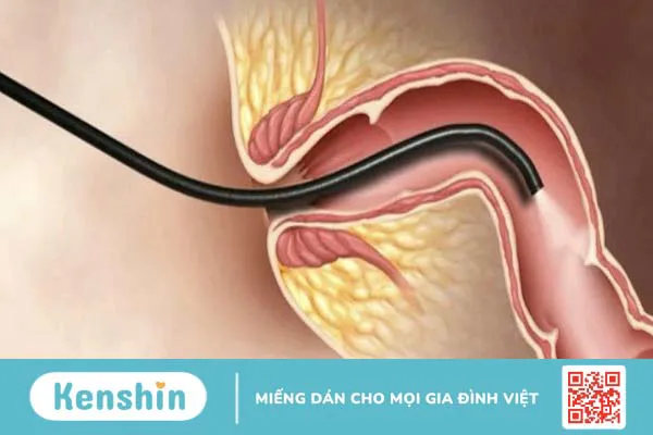 Sinh thiết trực tràng và những điều cần biết