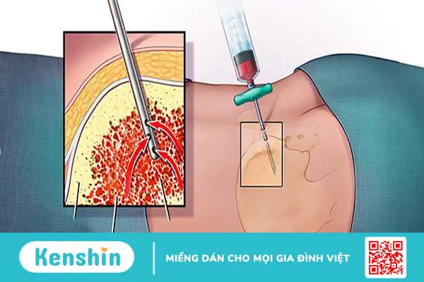 Sinh thiết tủy xương là gì? Quy trình và những điều cần lưu ý khi thực hiện