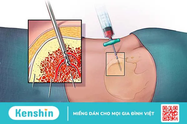 Sinh thiết tủy xương là gì? Quy trình và những điều cần lưu ý khi thực hiện